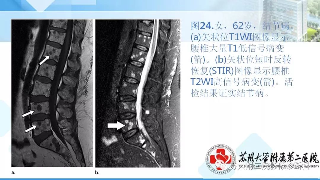 影像PPT - 【PPT】结节病-31