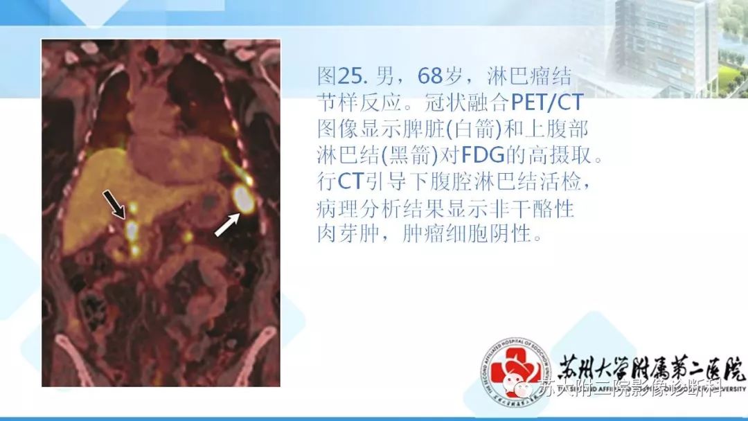 影像PPT - 【PPT】结节病-34