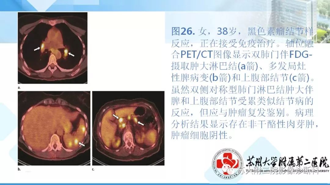 影像PPT - 【PPT】结节病-35
