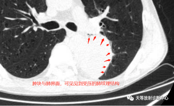 影像PPT - 【病例】肺大细胞神经内分泌癌1例CT影像-8 影像PPT - 【病例】肺大细胞神经内分泌癌1例CT影像-8