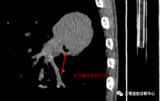 影像PPT - 【病例】肺大细胞神经内分泌癌1例CT影像-10 影像PPT - 【病例】肺大细胞神经内分泌癌1例CT影像-10