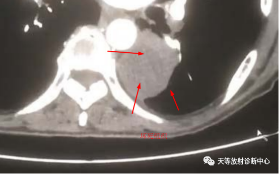 影像PPT - 【病例】肺大细胞神经内分泌癌1例CT影像-12 影像PPT - 【病例】肺大细胞神经内分泌癌1例CT影像-12