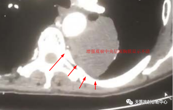 影像PPT - 【病例】肺大细胞神经内分泌癌1例CT影像-13 影像PPT - 【病例】肺大细胞神经内分泌癌1例CT影像-13