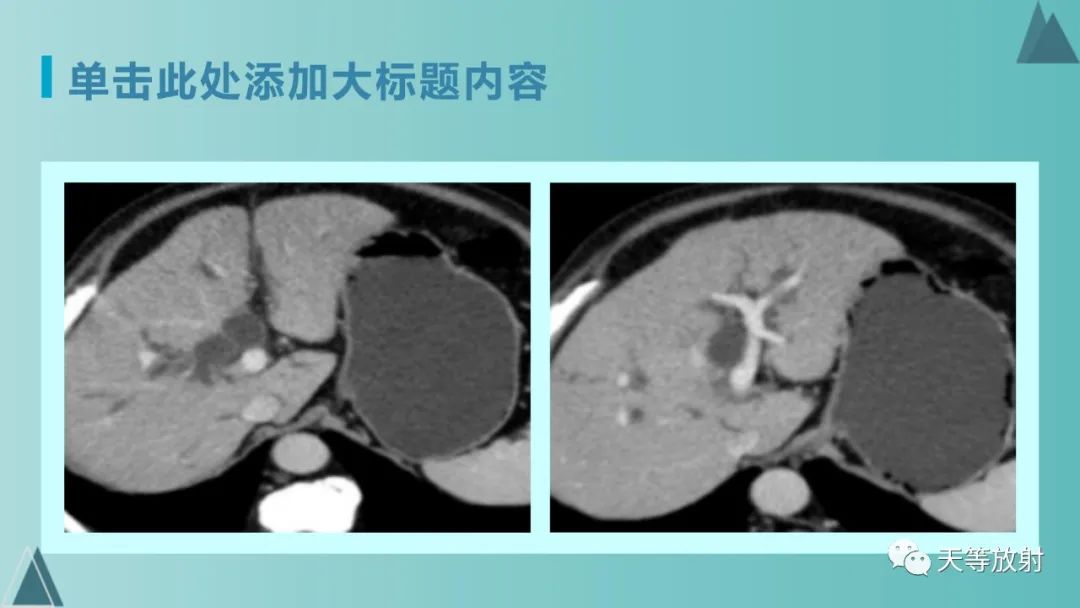 影像PPT - 【PPT】胆道梗阻的影像学诊断-4