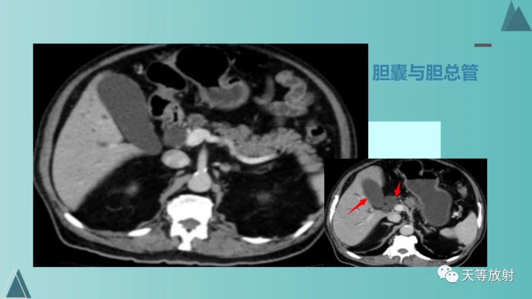 影像PPT - 【PPT】胆道梗阻的影像学诊断-5