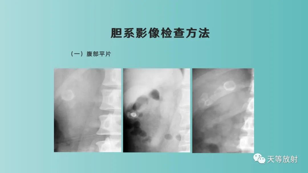 影像PPT - 【PPT】胆道梗阻的影像学诊断-6
