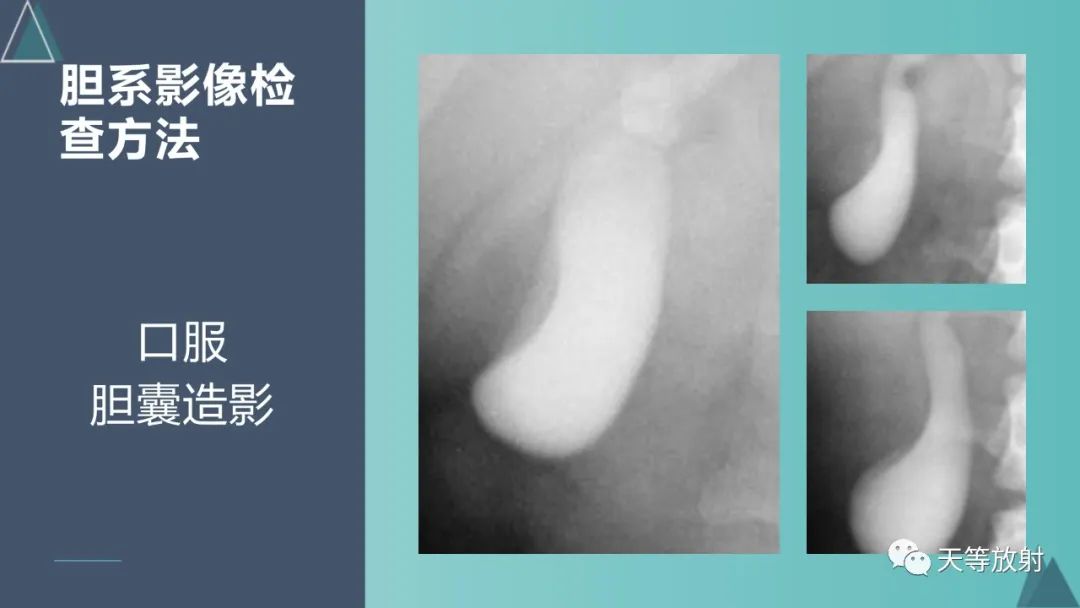 影像PPT - 【PPT】胆道梗阻的影像学诊断-7