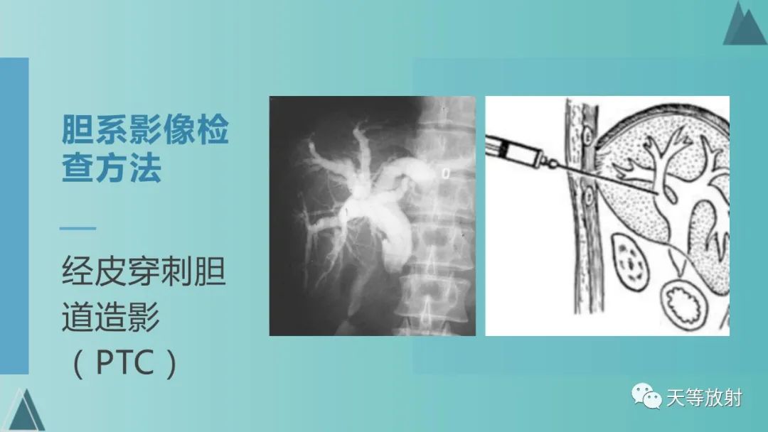 影像PPT - 【PPT】胆道梗阻的影像学诊断-9