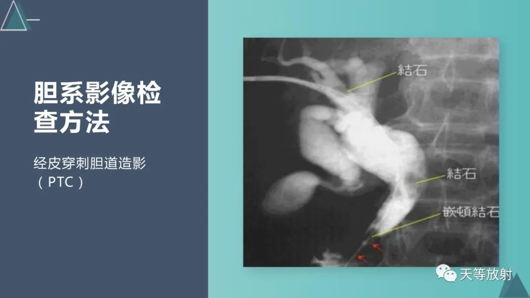 影像PPT - 【PPT】胆道梗阻的影像学诊断-10