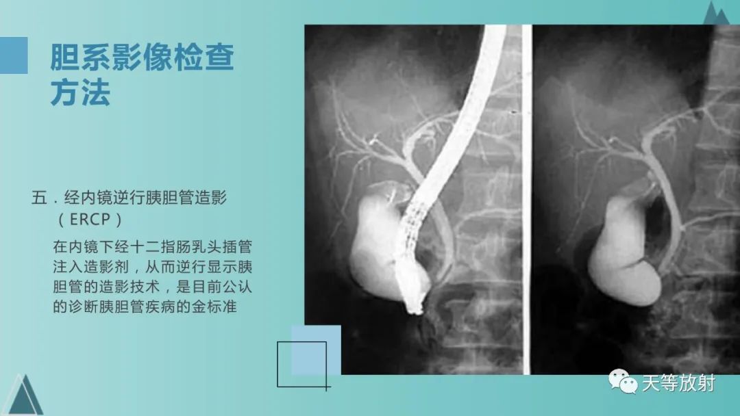 影像PPT - 【PPT】胆道梗阻的影像学诊断-11