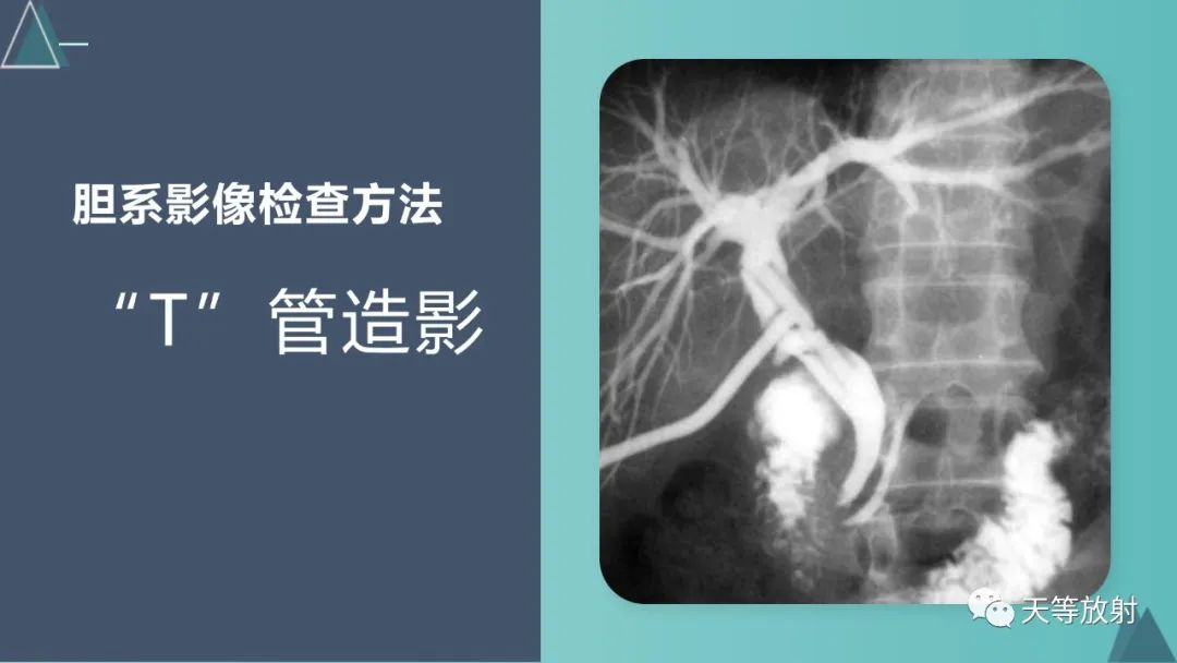 影像PPT - 【PPT】胆道梗阻的影像学诊断-12