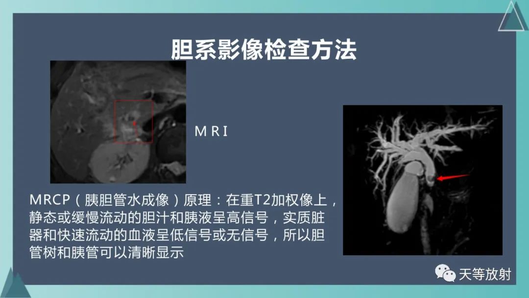 影像PPT - 【PPT】胆道梗阻的影像学诊断-14