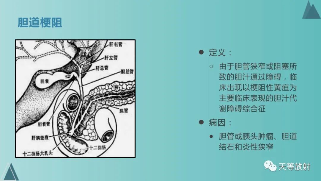 影像PPT - 【PPT】胆道梗阻的影像学诊断-19