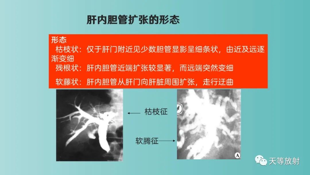影像PPT - 【PPT】胆道梗阻的影像学诊断-24