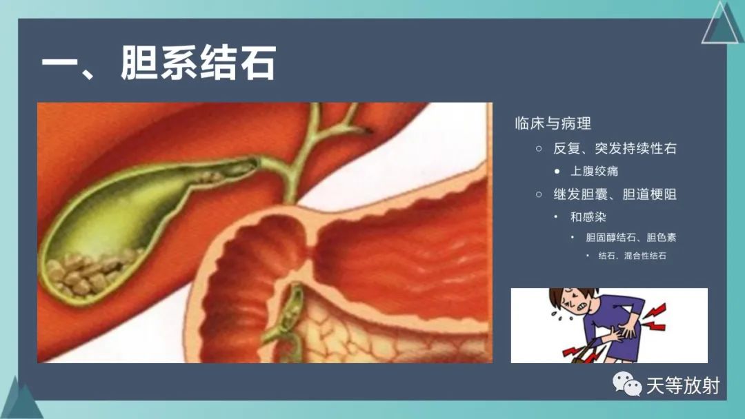 影像PPT - 【PPT】胆道梗阻的影像学诊断-29