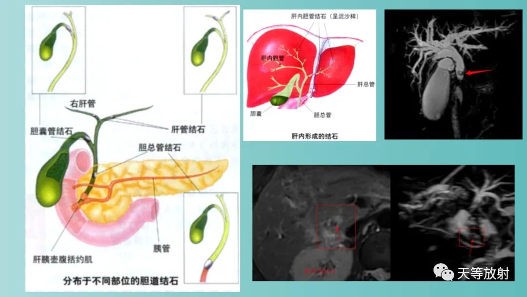 影像PPT - 【PPT】胆道梗阻的影像学诊断-32