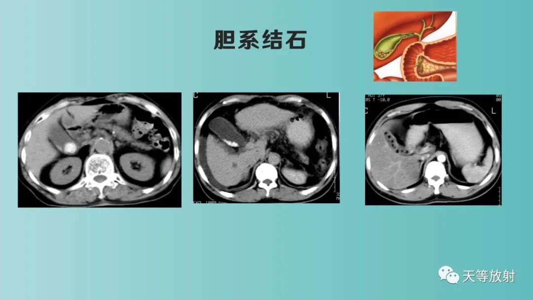 影像PPT - 【PPT】胆道梗阻的影像学诊断-33