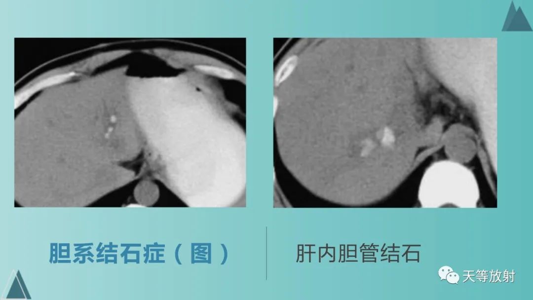影像PPT - 【PPT】胆道梗阻的影像学诊断-34