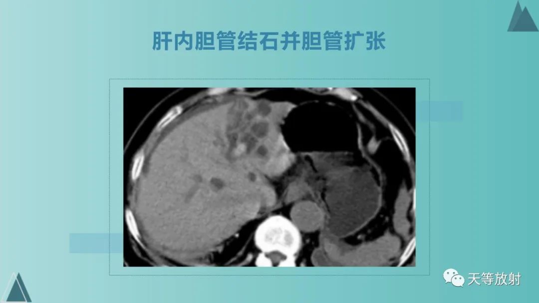 影像PPT - 【PPT】胆道梗阻的影像学诊断-35