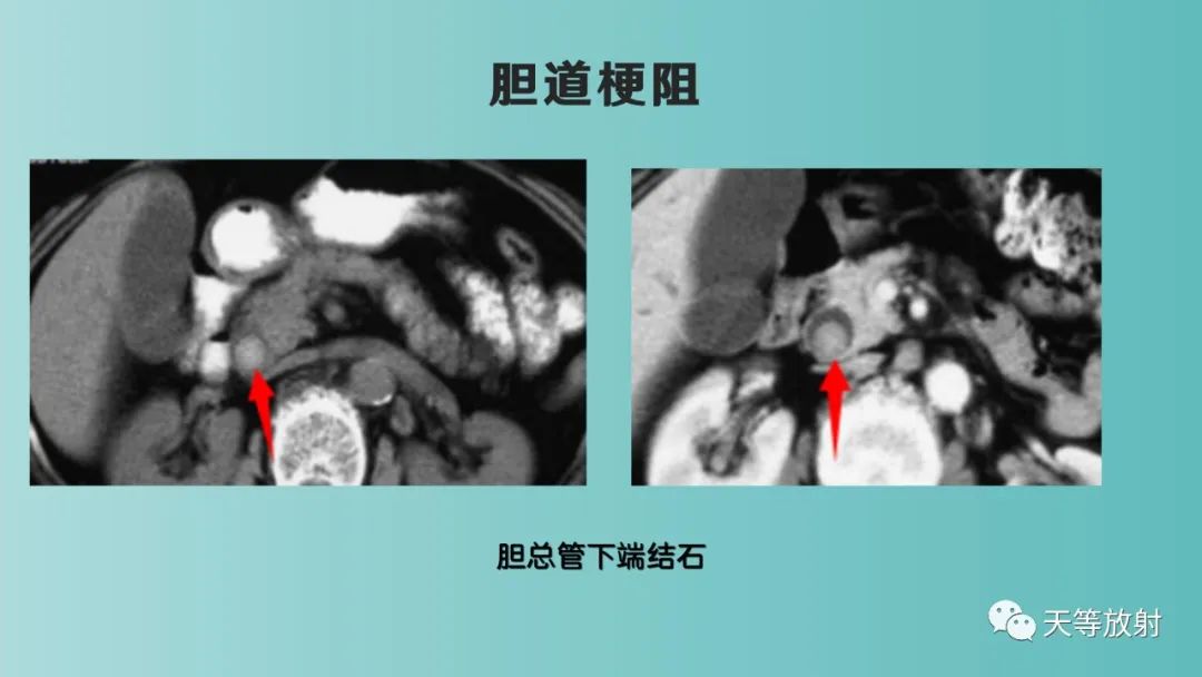 影像PPT - 【PPT】胆道梗阻的影像学诊断-36