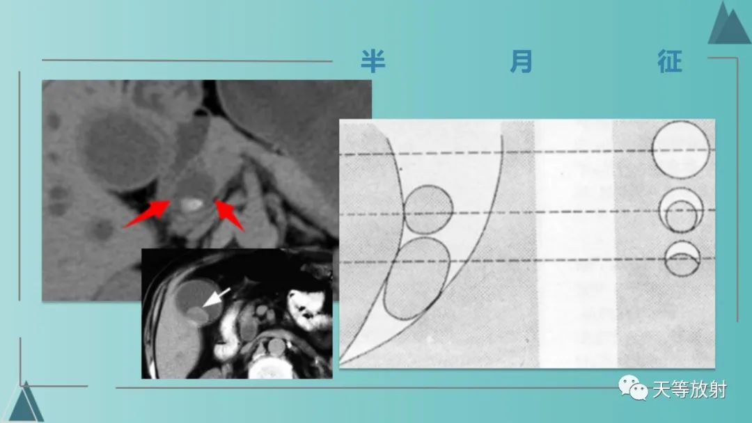 影像PPT - 【PPT】胆道梗阻的影像学诊断-37