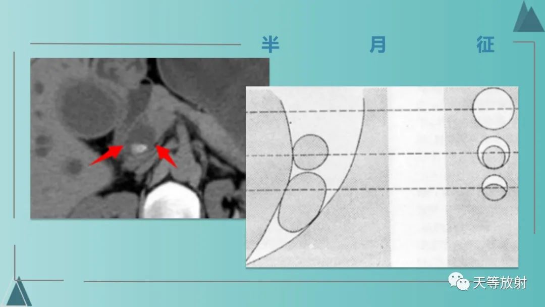 影像PPT - 【PPT】胆道梗阻的影像学诊断-38