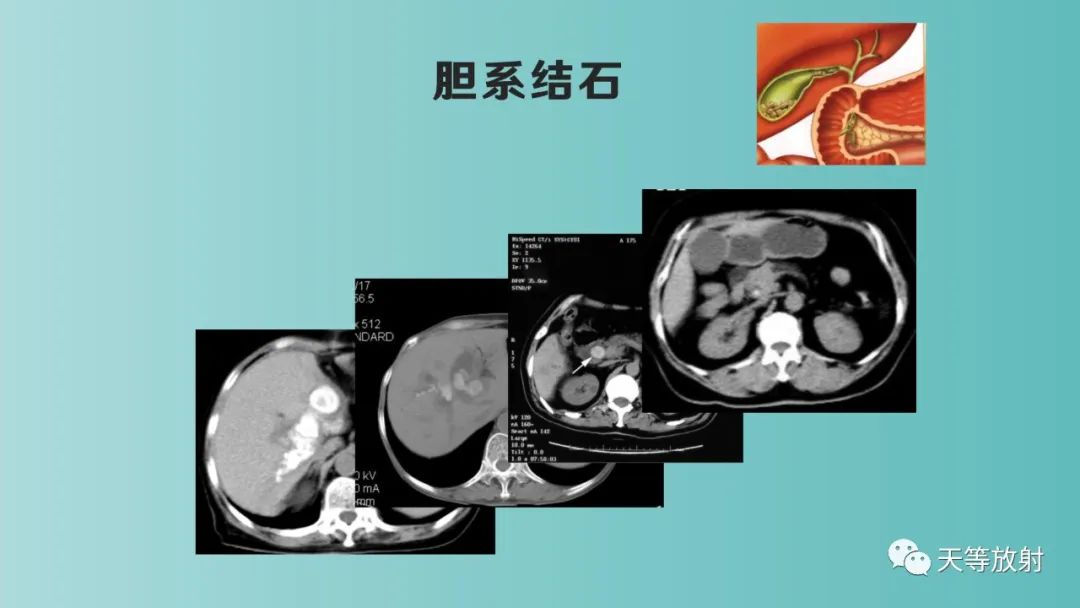 影像PPT - 【PPT】胆道梗阻的影像学诊断-40