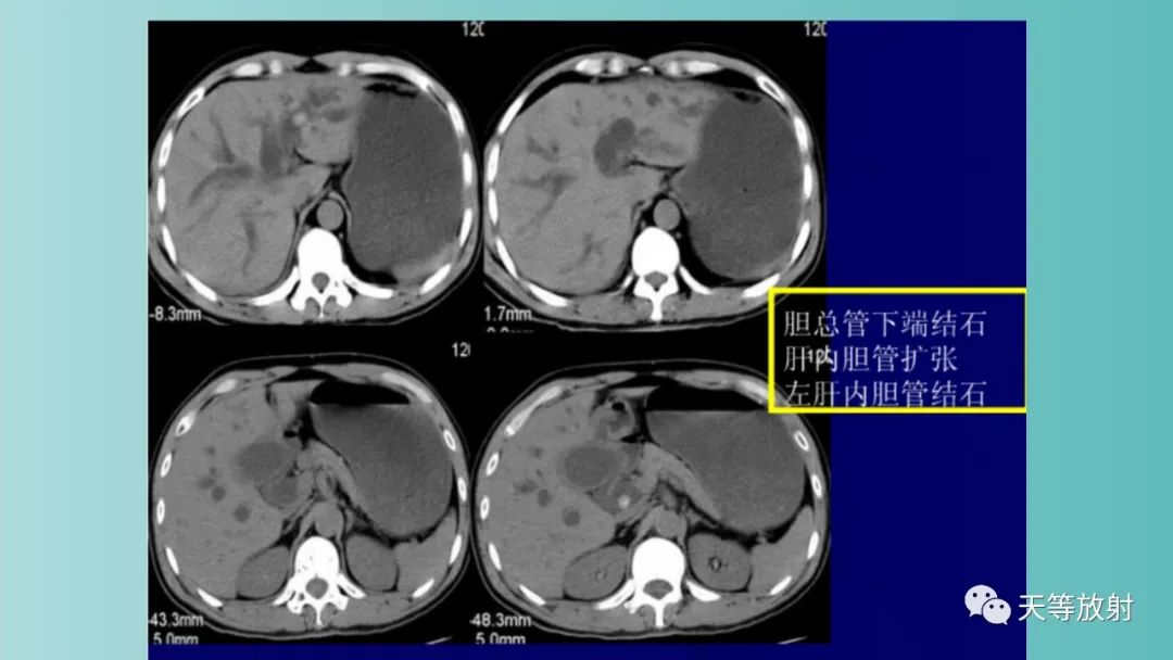 影像PPT - 【PPT】胆道梗阻的影像学诊断-41