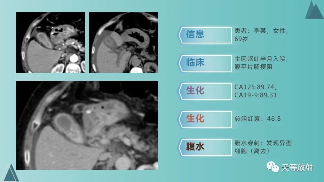影像PPT - 【PPT】胆道梗阻的影像学诊断-47