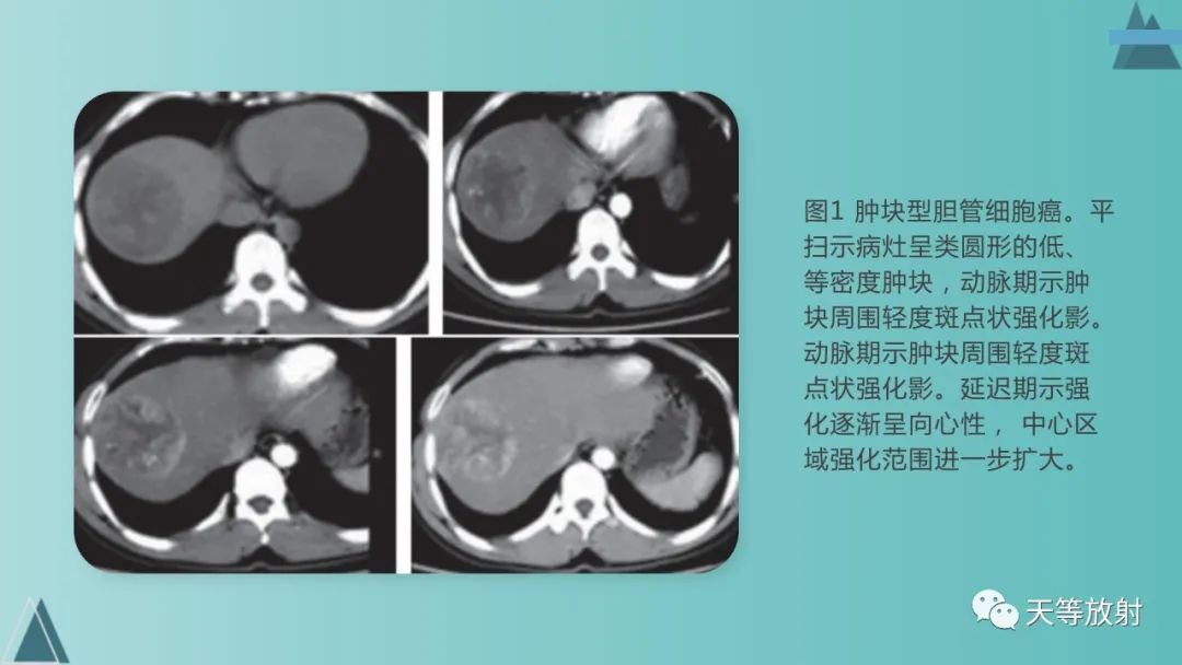影像PPT - 【PPT】胆道梗阻的影像学诊断-52