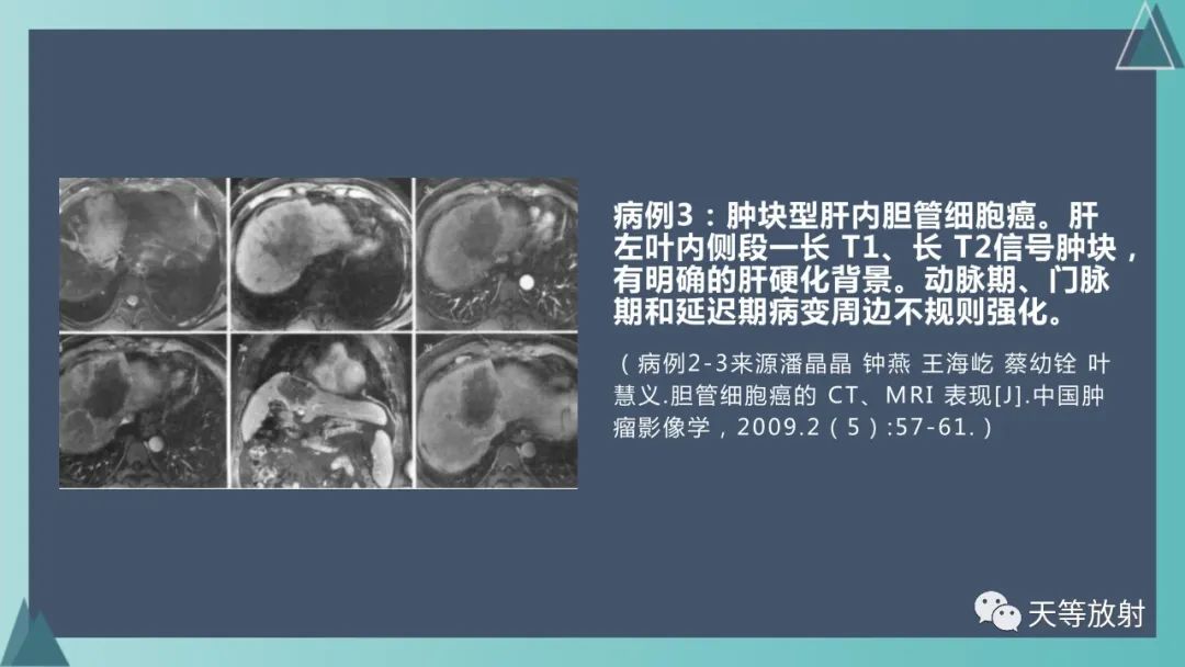 影像PPT - 【PPT】胆道梗阻的影像学诊断-53