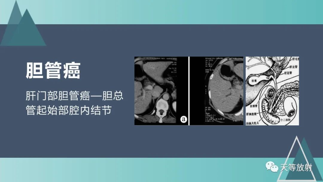 影像PPT - 【PPT】胆道梗阻的影像学诊断-54