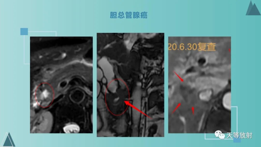影像PPT - 【PPT】胆道梗阻的影像学诊断-55
