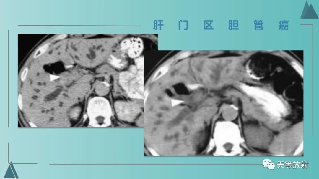 影像PPT - 【PPT】胆道梗阻的影像学诊断-57
