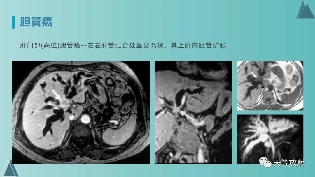 影像PPT - 【PPT】胆道梗阻的影像学诊断-56