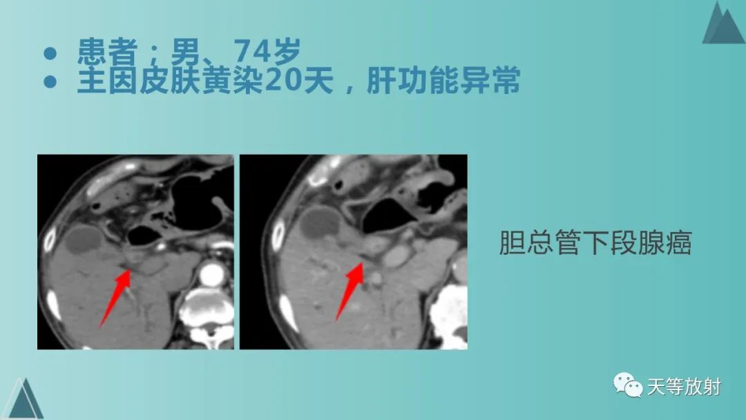 影像PPT - 【PPT】胆道梗阻的影像学诊断-58