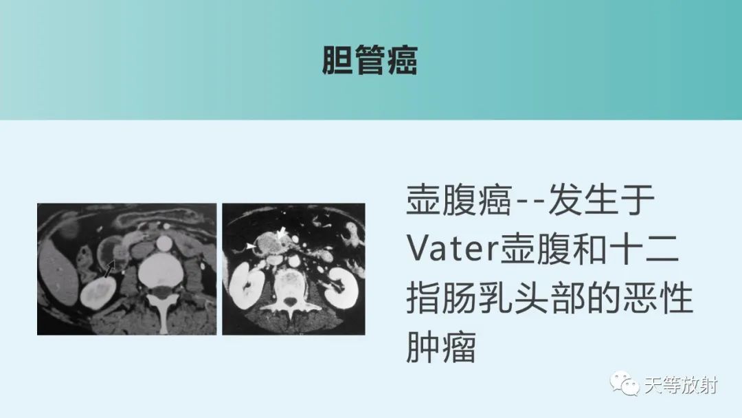 影像PPT - 【PPT】胆道梗阻的影像学诊断-59