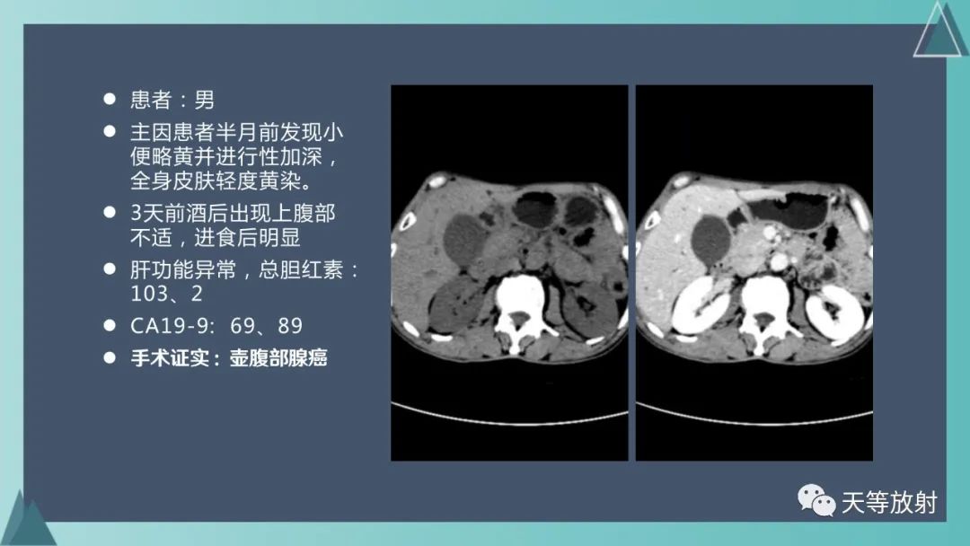 影像PPT - 【PPT】胆道梗阻的影像学诊断-60