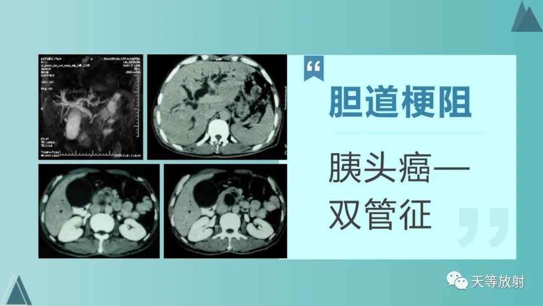 影像PPT - 【PPT】胆道梗阻的影像学诊断-70
