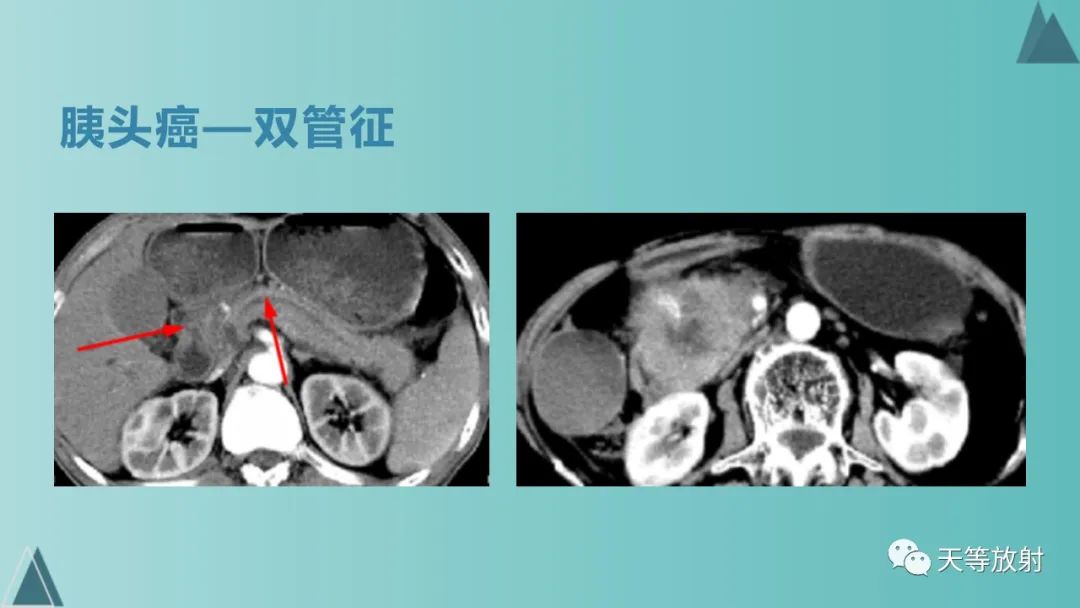 影像PPT - 【PPT】胆道梗阻的影像学诊断-71