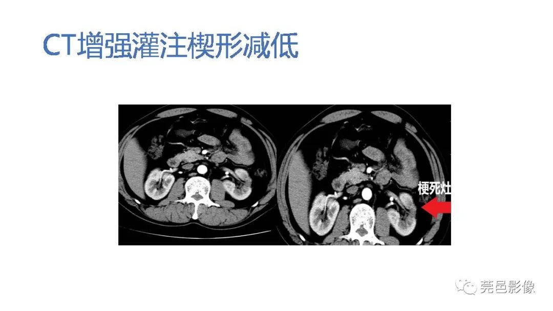 影像PPT - 【PPT】自发性肾动脉夹层CT诊断-14