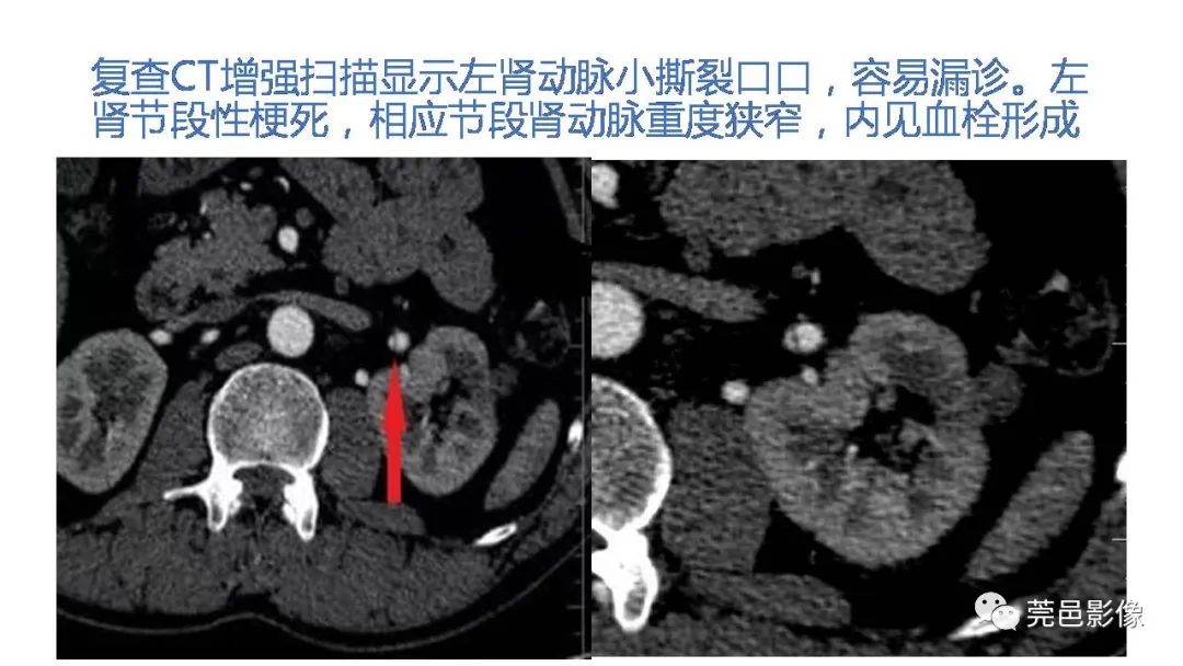 影像PPT - 【PPT】自发性肾动脉夹层CT诊断-17