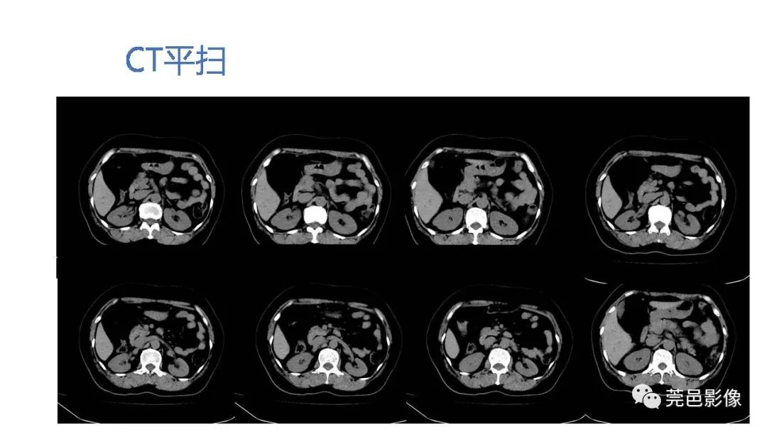 影像PPT - 【PPT】自发性肾动脉夹层CT诊断-25