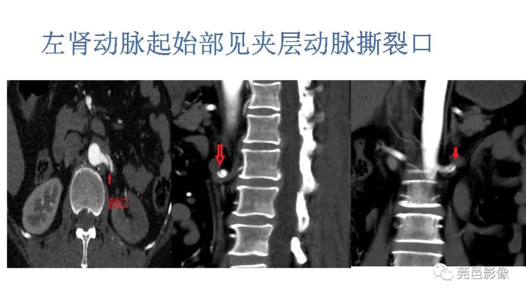 影像PPT - 【PPT】自发性肾动脉夹层CT诊断-27