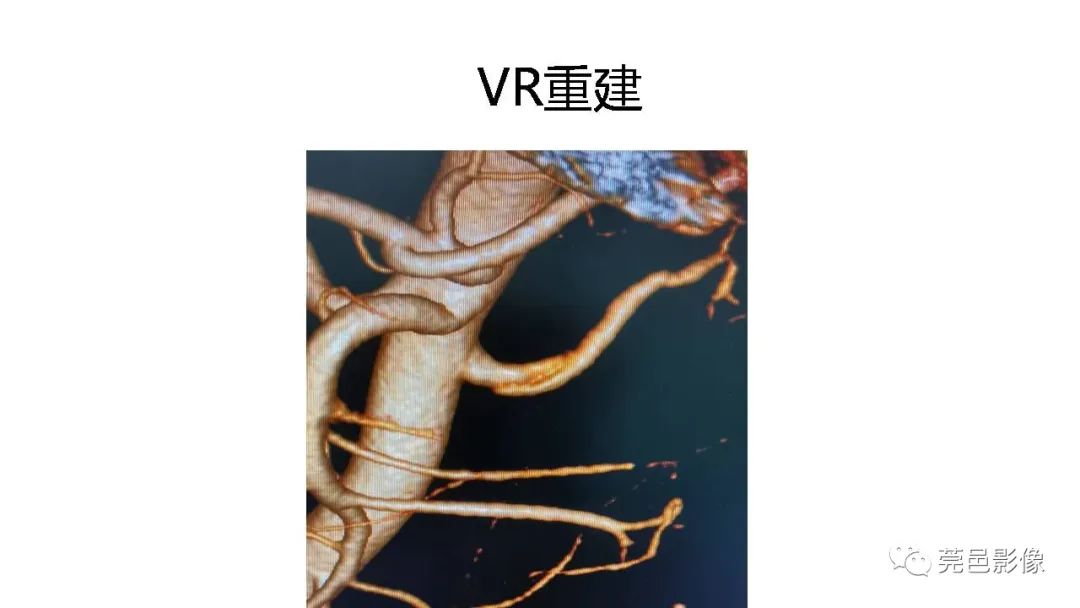 影像PPT - 【PPT】自发性肾动脉夹层CT诊断-28