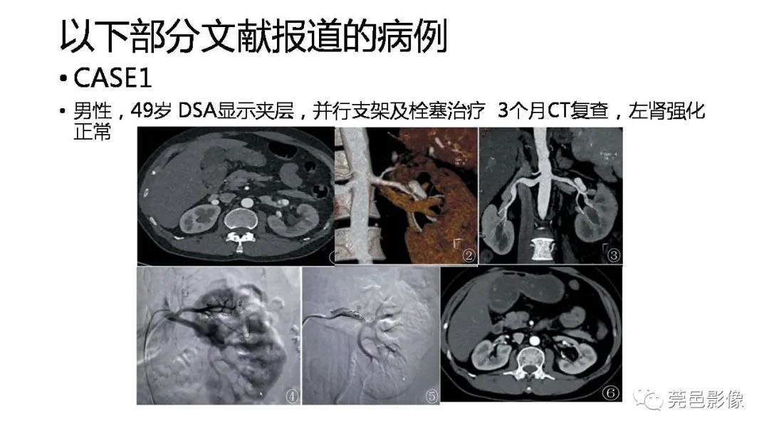 影像PPT - 【PPT】自发性肾动脉夹层CT诊断-29