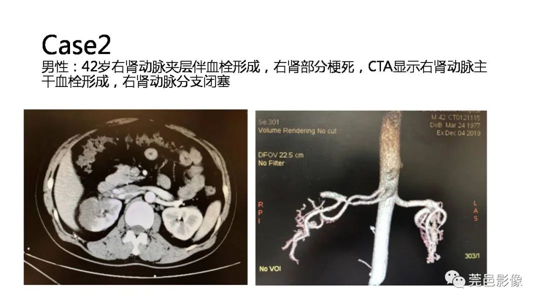 影像PPT - 【PPT】自发性肾动脉夹层CT诊断-30