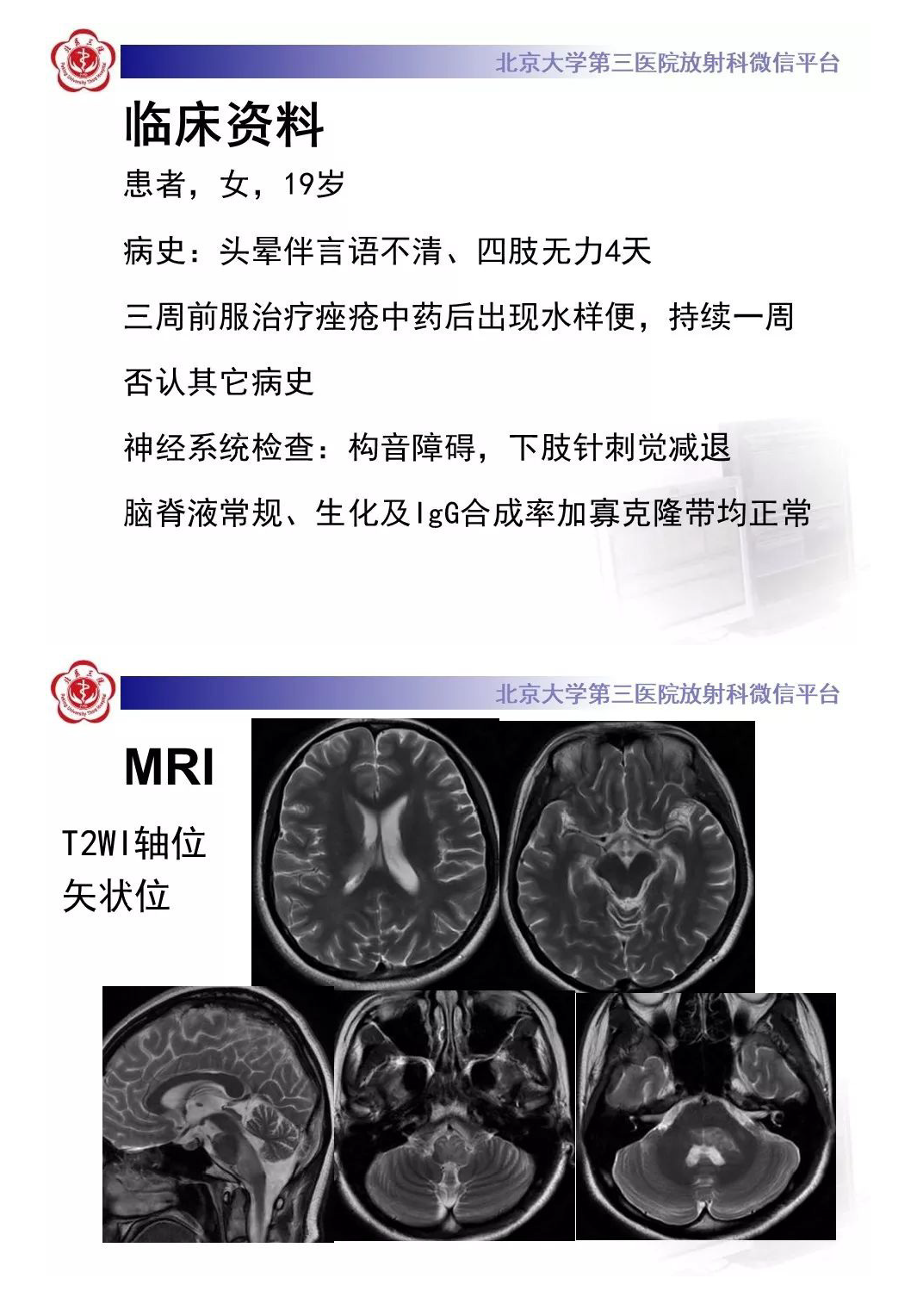 影像PPT - 【PPT】急性播散性脑脊髓炎-2