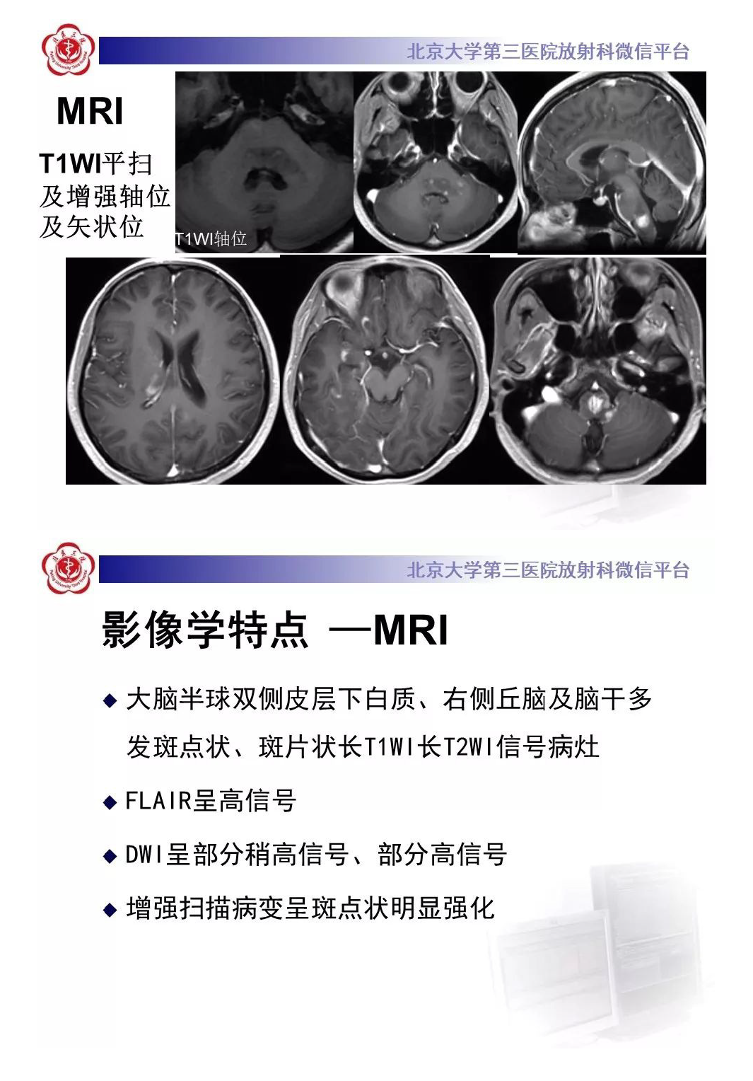影像PPT - 【PPT】急性播散性脑脊髓炎-4
