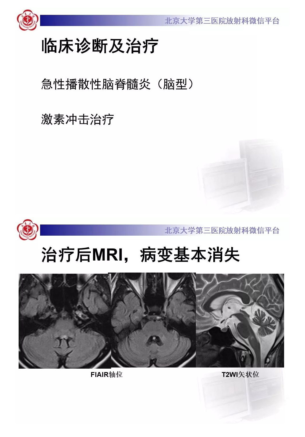影像PPT - 【PPT】急性播散性脑脊髓炎-5